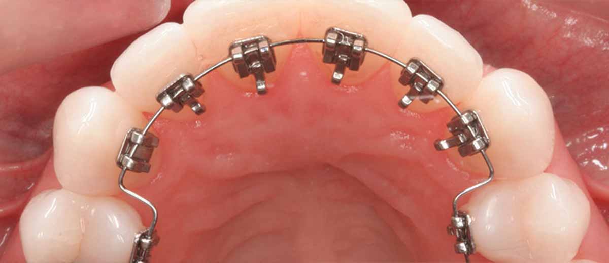 Ortodonti Nedir
