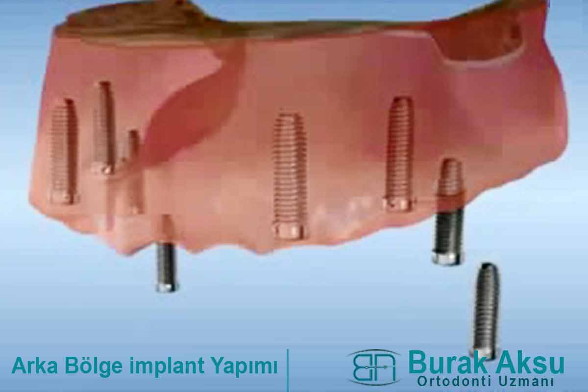 Arka Bölge implant Yapımı
