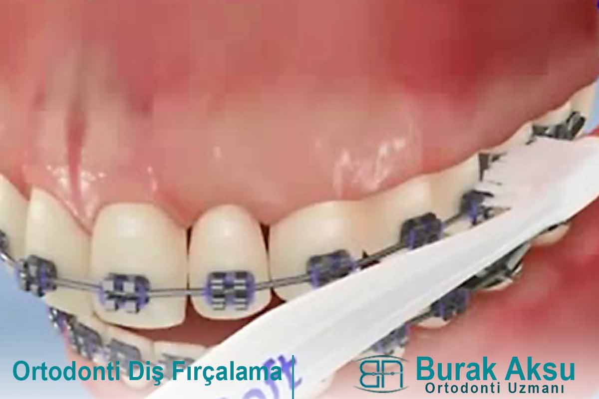 Ortodonti Diş Fırçalama