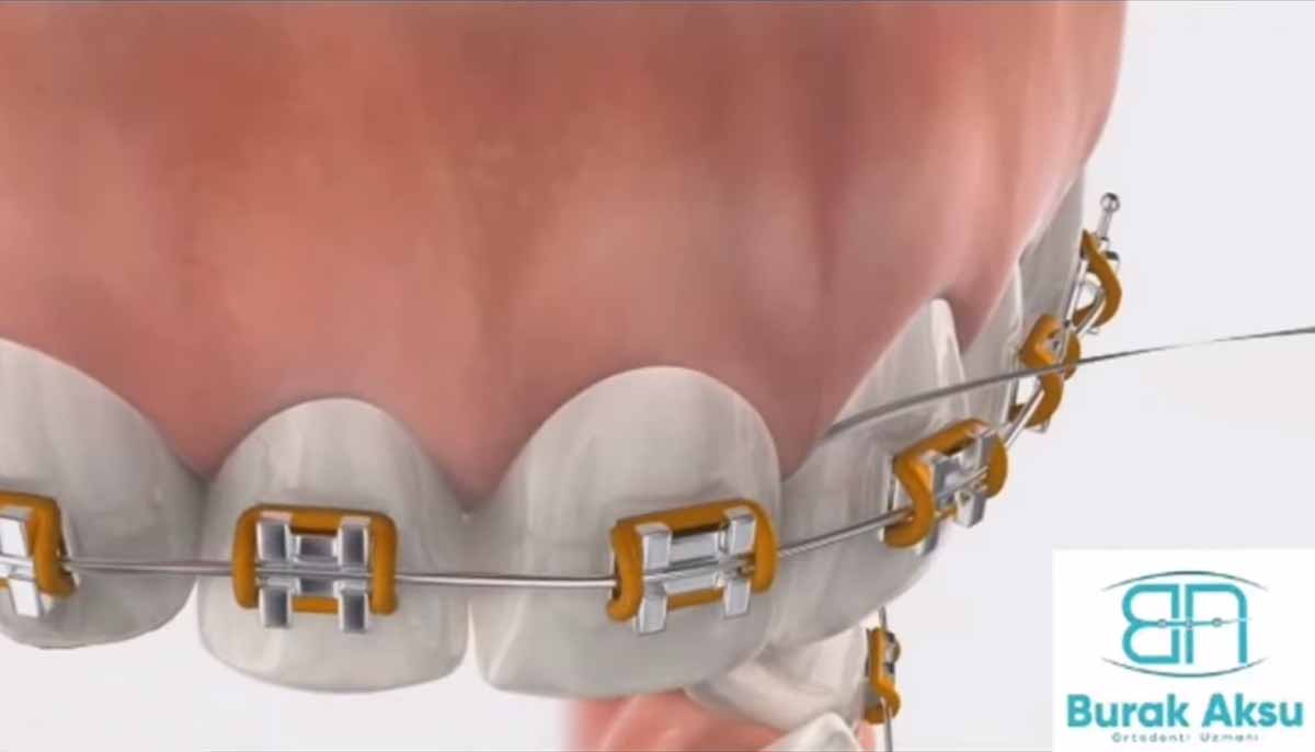 Ortodontik Tedavide Superfloss Diş ipi Kullanımı Nasıl Olmalıdır